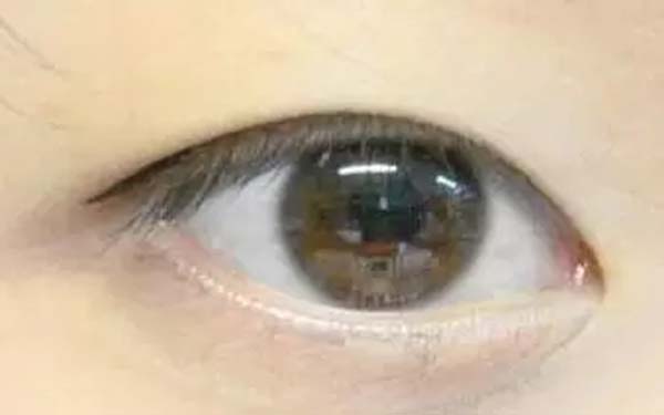 开眼角手术大概做多久恢复自然