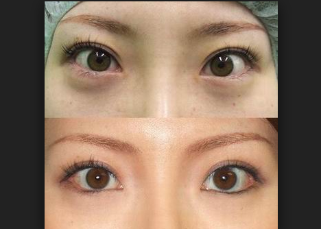 大连开眼角手术价格