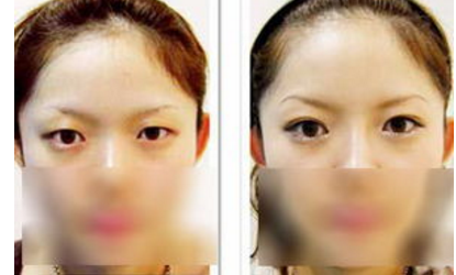 开内眼角后还会回缩吗 开内眼角后还会回缩吗