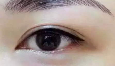 做了双眼皮后多久可以恢复 做了双眼皮后多久可以恢复