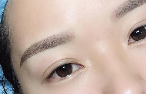 埋线重睑术需要多久