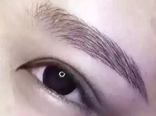 三点式双眼皮手术有什么风险