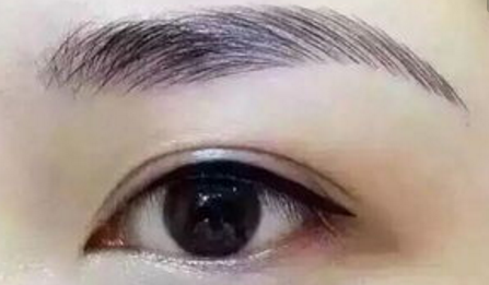 开双眼皮后怎么护理