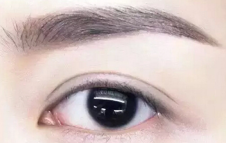 双眼皮整形多久能洗澡 双眼皮整形多久能洗澡