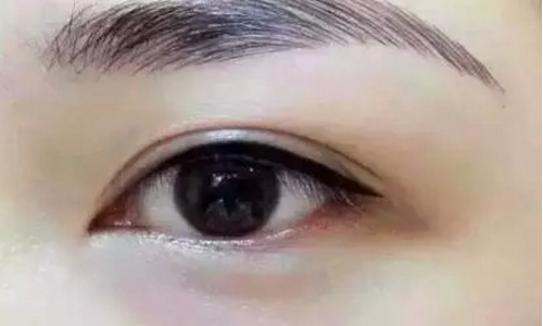 除眼袋后的恢复期