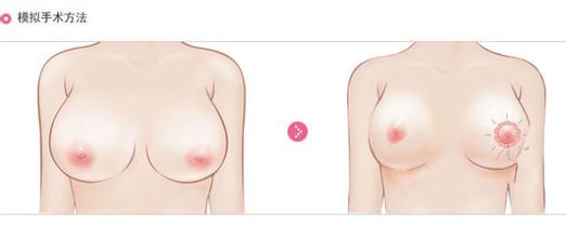 巨乳缩小术的价格及手术准备工作