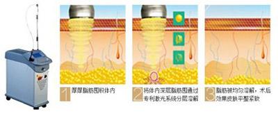 太原激光溶脂瘦大腿哪家医美整形医院好? 太原激光溶脂瘦大腿哪家医美整形医院好?