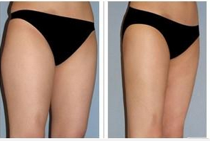 腿部吸脂有没有危害