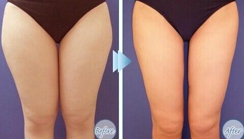超声吸脂瘦大腿前后明显吗