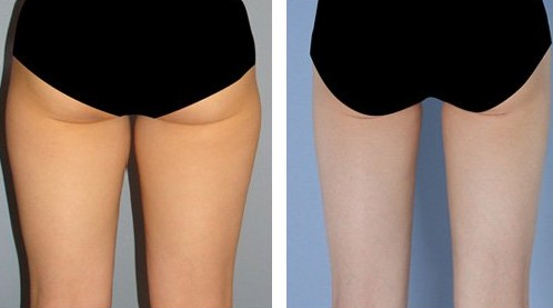 大腿抽脂一般价格