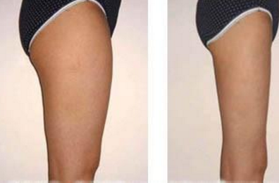 吸脂瘦腿效果好不好