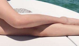 大腿抽脂的后遗症 大腿抽脂的后遗症