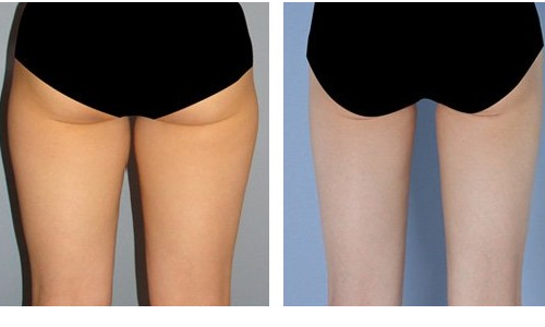 怎么把腿瘦下来 怎么把腿瘦下来