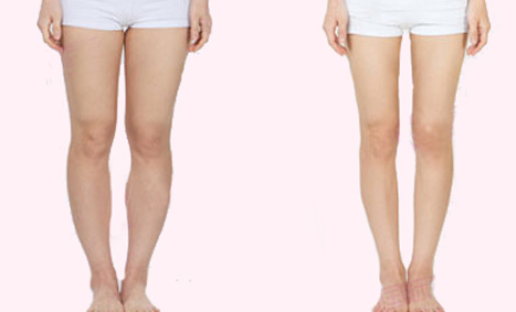 腿部抽脂多久可以正常走路 腿部抽脂多久可以正常走路