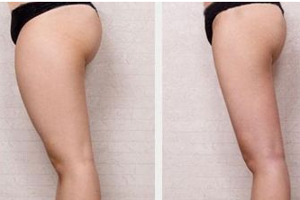 抽脂瘦腿的后遗症是什么 抽脂瘦腿的后遗症是什么