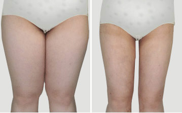 大腿抽脂多久可以完全恢复 大腿抽脂多久可以完全恢复