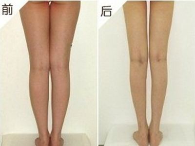 如何进行腿部吸脂