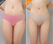 大腿光电溶脂术后恢复效果图 大腿光电溶脂术后恢复效果图