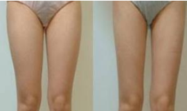 大腿光电溶脂可以保持多久呢 大腿光电溶脂可以保持多久呢