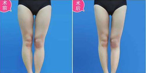 肌肉腿能抽脂吗 肌肉腿能抽脂吗