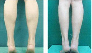 请问腿部抽脂多少钱 容易反弹吗 请问腿部抽脂多少钱 容易反弹吗