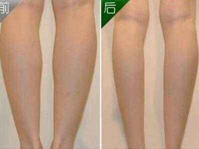 腿部吸脂的副作用怎么避免 腿部吸脂的副作用怎么避免