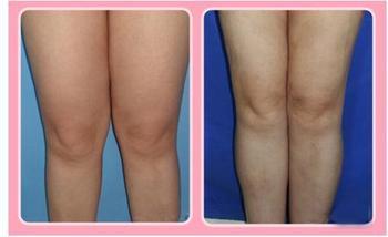 腿部的吸脂手术后需要多长时间才能恢复 腿部的吸脂手术后需要多长时间才能恢复