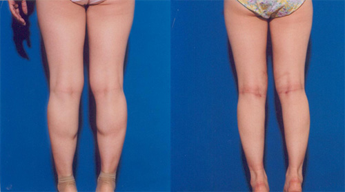 上海大腿吸脂效果及价格 上海大腿吸脂效果及价格