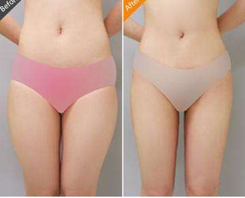 大腿吸脂减肥的优势有哪些 大腿吸脂减肥的优势有哪些