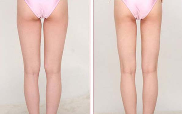 动力吸脂手术可以做大腿吸脂吗? 动力吸脂手术可以做大腿吸脂吗?