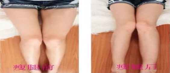 上海大腿环吸多少钱 上海大腿环吸多少钱