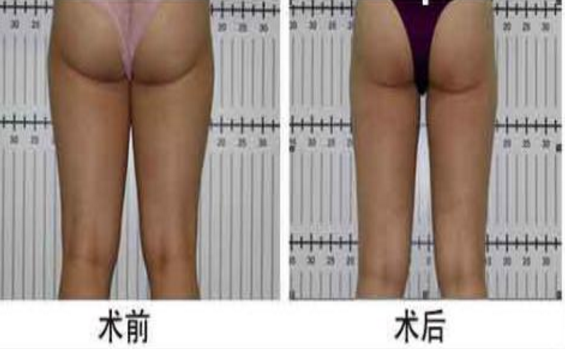 大腿吸脂术是否有危险 大腿吸脂术是否有危险