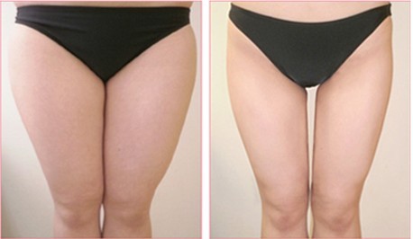 腿部吸脂的费用大概多少?