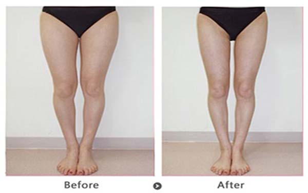 大腿吸脂后多久能下床 大腿吸脂后多久能下床