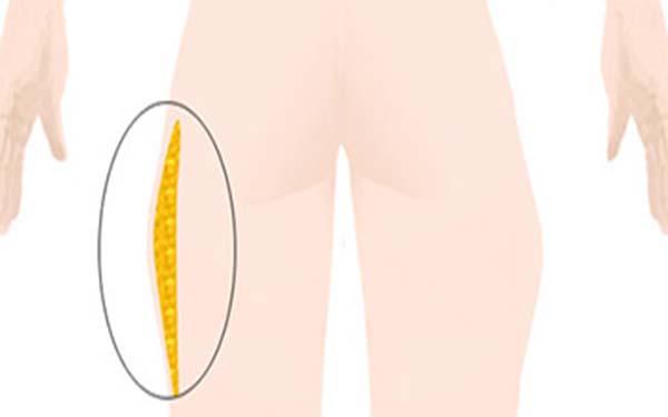 腿部脂肪堆积的原因 腿部脂肪堆积的原因