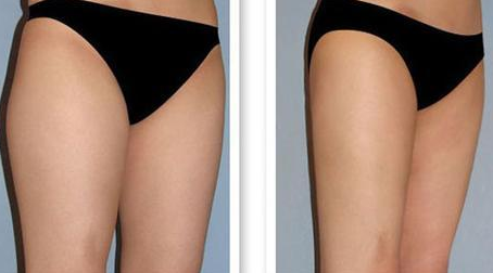 大腿肉松弛容易减吗 大腿肉松弛容易减吗