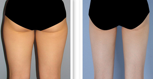 大腿吸脂后会反弹吗? 大腿吸脂后会反弹吗?