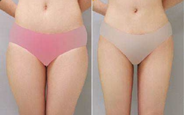大腿溶脂和吸脂哪个效果好 大腿溶脂和吸脂哪个效果好