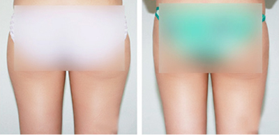 大腿吸脂手术费用大概是多少 大腿吸脂手术费用大概是多少