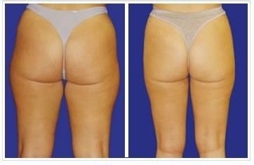 吸脂瘦大腿的安全和注意事项 吸脂瘦大腿的安全和注意事项