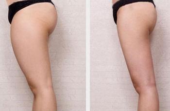 大腿吸脂后早期需进行轻度活动吗 大腿吸脂后早期需进行轻度活动吗