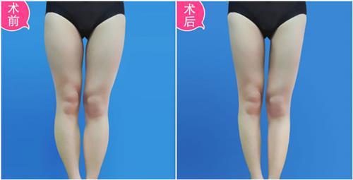 大腿吸脂手术大概需要几天恢复 大腿吸脂手术大概需要几天恢复