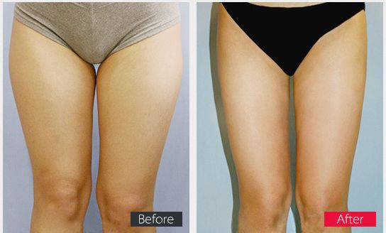 大腿吸脂后多久能运动 大腿吸脂后多久能运动