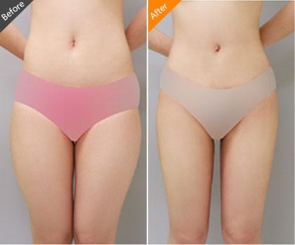 水动力吸脂瘦大腿前后对比图 水动力吸脂瘦大腿前后对比图