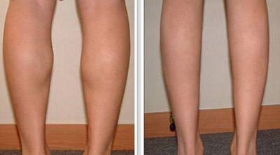 打一针注射瘦腿价格