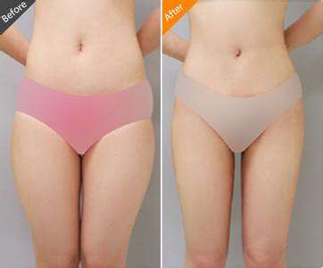 大腿吸脂术后消肿方法 大腿吸脂术后消肿方法