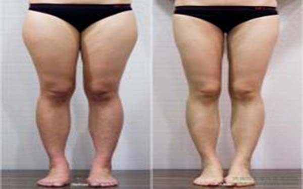 吸脂瘦腿会反弹吗? 吸脂瘦腿会反弹吗?