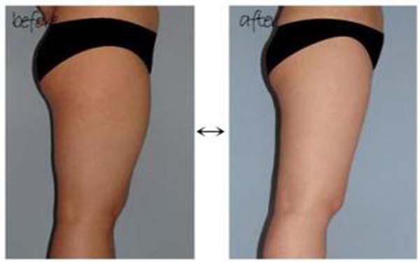 大腿抽脂后怎么消肿快 大腿抽脂后怎么消肿快