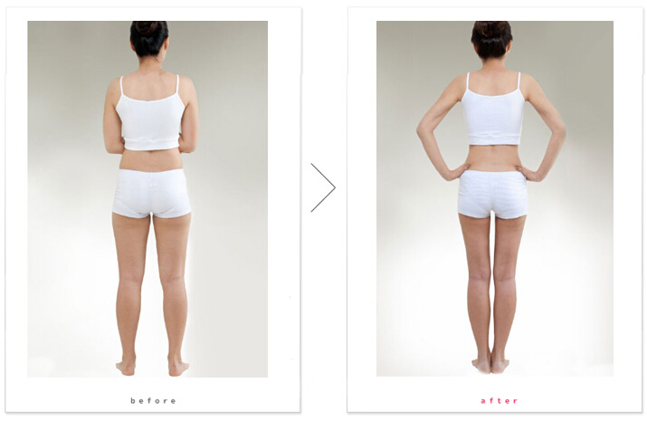 大腿吸脂一个月反粗了怎么回事 大腿吸脂一个月反粗了怎么回事