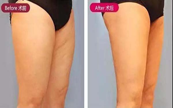 大腿吸脂后积液危害 大腿吸脂后积液危害